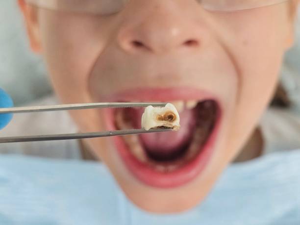 Best Knocked-Out Tooth Emergency  in Honeygo, MD