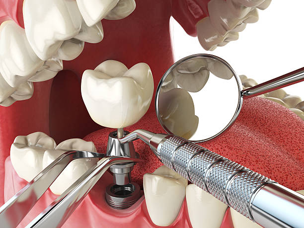 Tooth Infection Emergency Dentist in MD